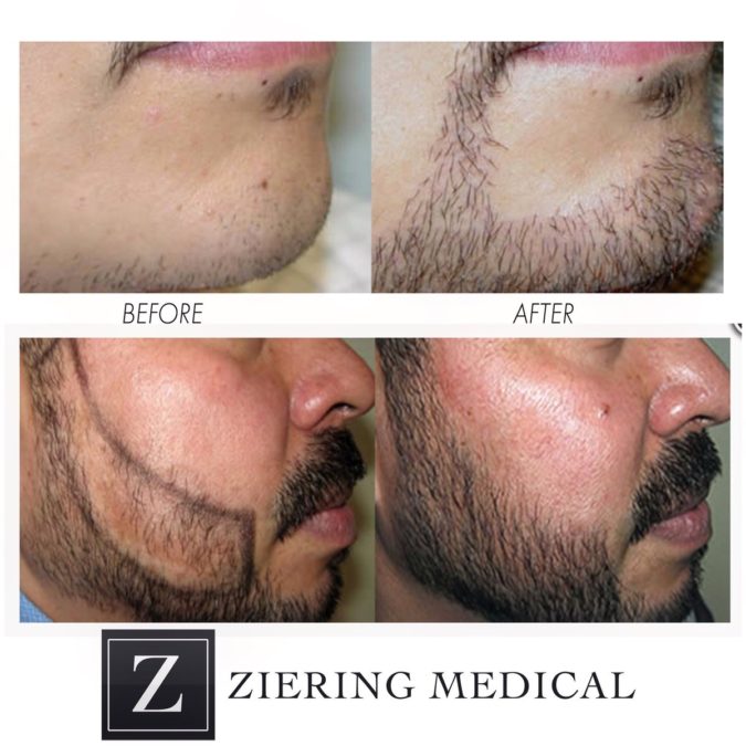 Ziering Medical Top 10 Hair Transplant Clinics in the USA - 3