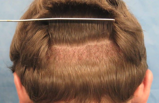 Best 10 Hair Transplant Clinics in Dubai 26 hair transplant 1 Best 10 Hair Transplant Clinics in Dubai - 26