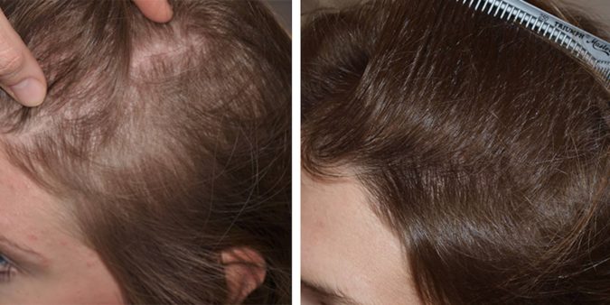 Best 10 Hair Transplant Clinics in Dubai 3 hair transplant Best 10 Hair Transplant Clinics in Dubai - 3