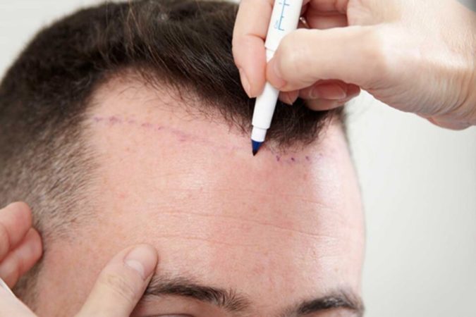 Best 10 Hair Transplant Clinics in Dubai 5 hair transplant hairline Best 10 Hair Transplant Clinics in Dubai - 5