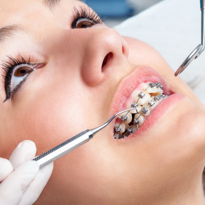 Orthodontics-675x675 3 Types of Cosmetic Dental Procedures That Will Work Wonders for Your Smile