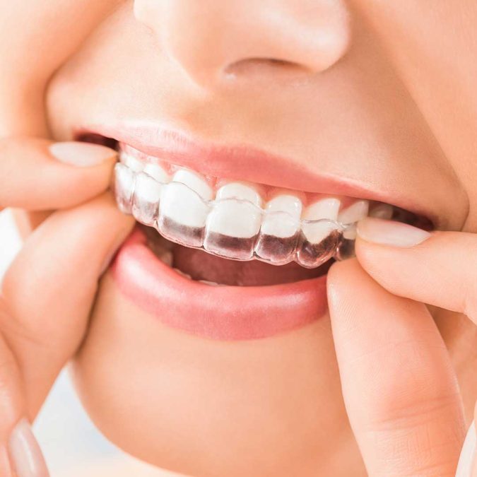3 Types of Cosmetic Dental Procedures That Will Work Wonders for Your Smile 4 Orthodontics. 3 Types of Cosmetic Dental Procedures That Will Work Wonders for Your Smile - 4