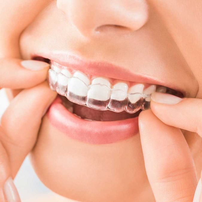 Orthodontics. 3 Types of Cosmetic Dental Procedures That Will Work Wonders for Your Smile - 4