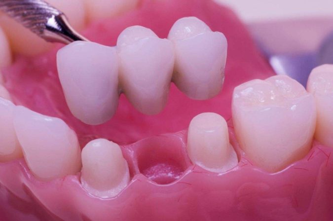crowns-and-bridges-1-675x448 3 Types of Cosmetic Dental Procedures That Will Work Wonders for Your Smile