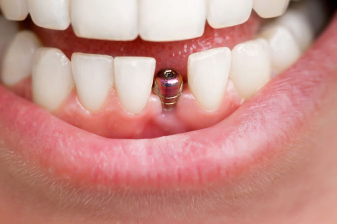 3 Types of Cosmetic Dental Procedures That Will Work Wonders for Your Smile 5 dental implants 3 Types of Cosmetic Dental Procedures That Will Work Wonders for Your Smile - 5
