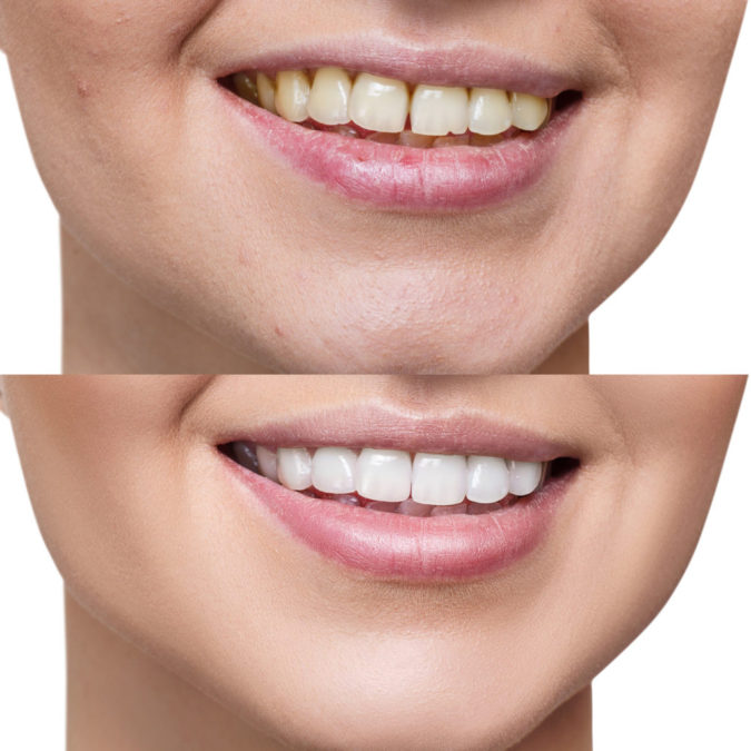 3 Types of Cosmetic Dental Procedures That Will Work Wonders for Your Smile 6 dental veneers 1 3 Types of Cosmetic Dental Procedures That Will Work Wonders for Your Smile - 6