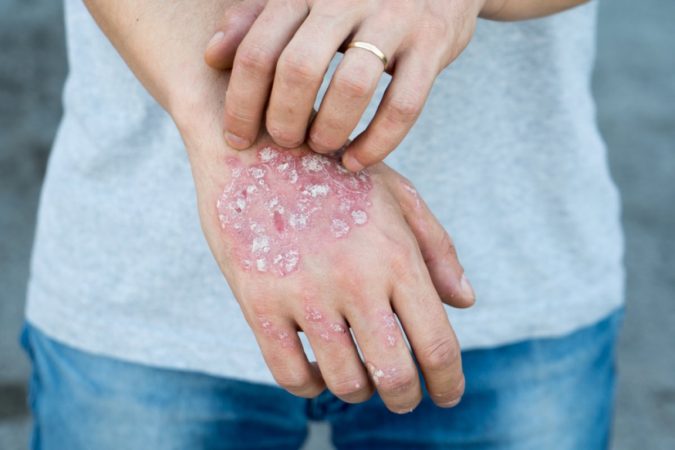 psoriasis Top 10 CBD Hand Sanitizer Benefits - 13