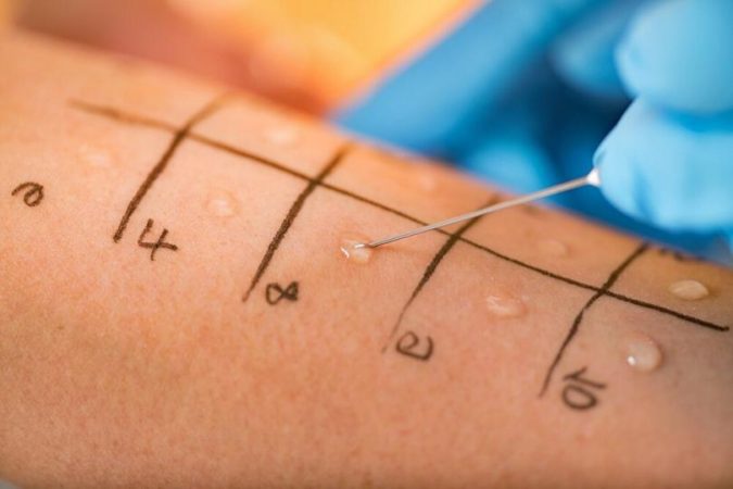 Are Allergies Passed from Parent to Child? 9 allergy Prick testing Are Allergies Passed from Parent to Child? - 9