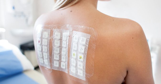 Are Allergies Passed from Parent to Child? 11 allergy patch testing Are Allergies Passed from Parent to Child? - 11