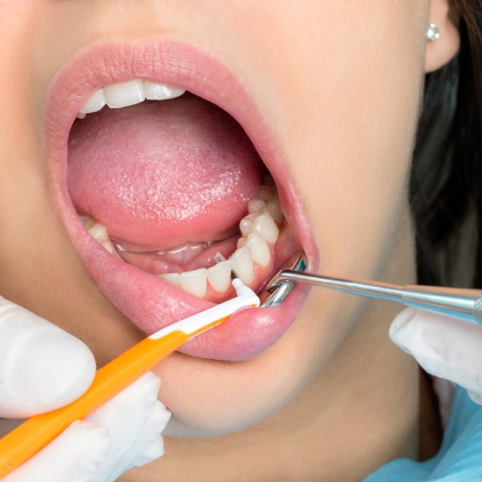 interdental cleaning 1 Your Complete Guide for Fixing Dental Issues - 5