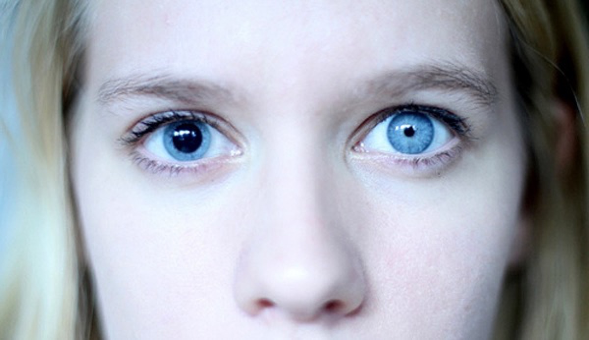 Anisocoria 7 Rarest and Unusual Eye Colors That Looks Unreal - 3