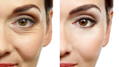 Here’s How to Prevent the Formation of Wrinkles 1 microneeedling
