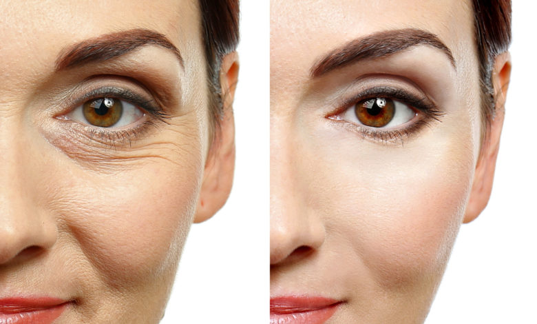 Here’s How to Prevent the Formation of Wrinkles 1 microneeedling