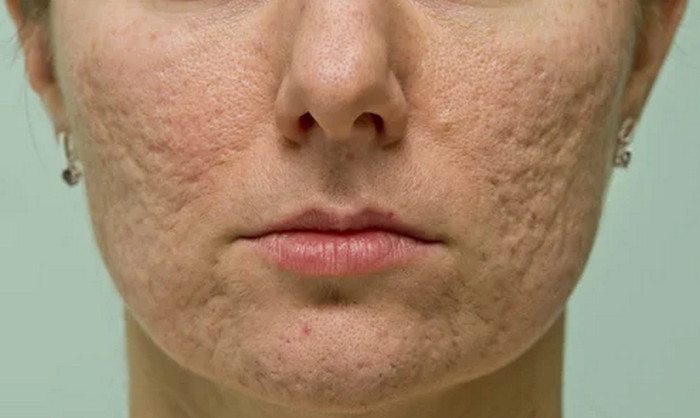 perimenopause acnes