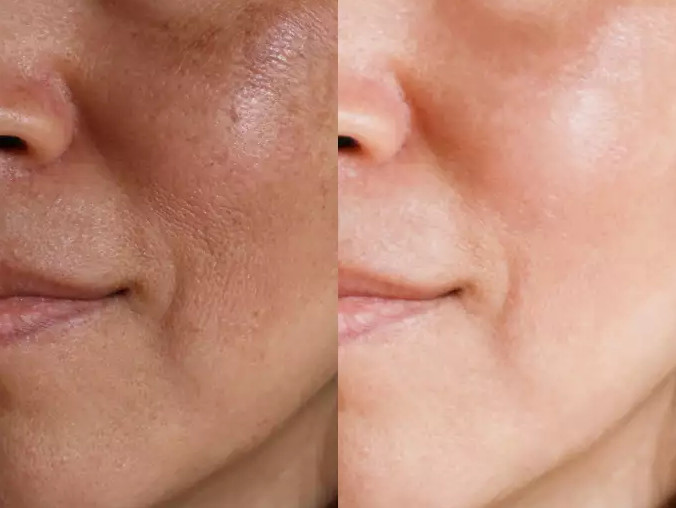 shrinking skin pores
