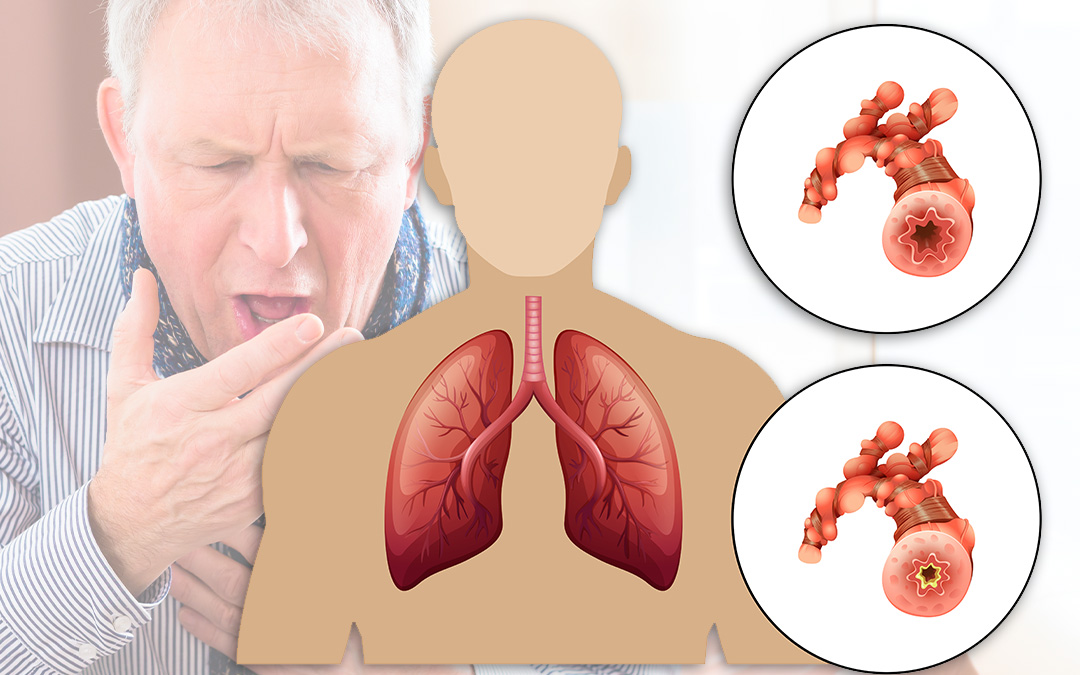 Chronic-Obstructive-Pulmonary-Disease-COPD 7 Top Health Threats to Men