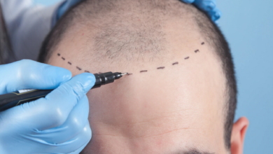 hair transplant