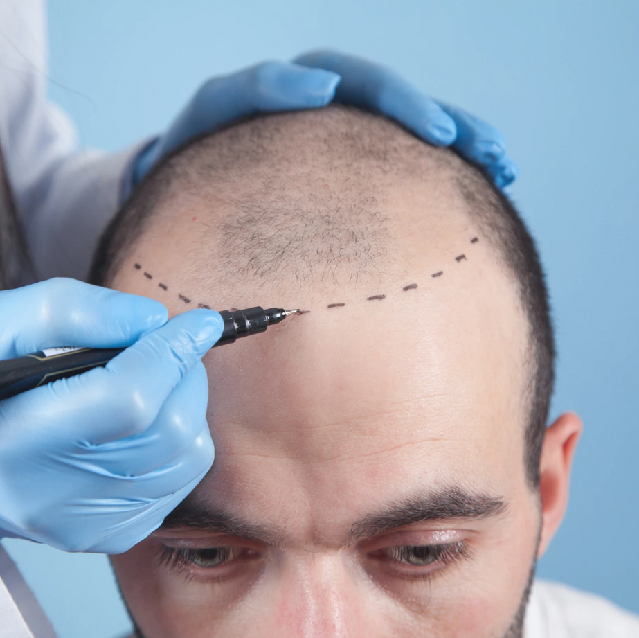 hair-transplant Cosmetic Procedures to Combat Common Aging