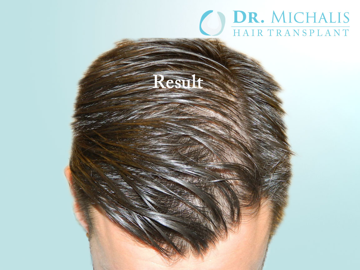 Top 10 BEST Hair Transplant Clinics in Europe 16 Dr. Michalis FUE Hair Transplant Clinic Barcelona 1 Top 10 BEST Hair Transplant Clinics in Europe - 14