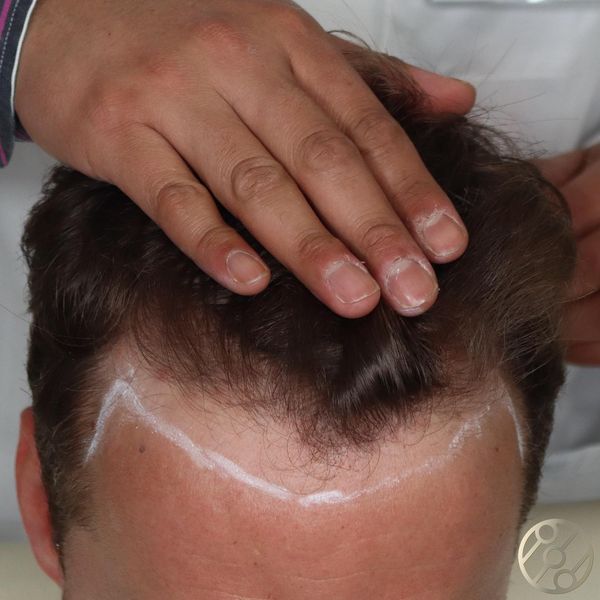 Top 10 BEST Hair Transplant Clinics in Europe 14 Instituto Medico del Prado Madrid 1 Top 10 BEST Hair Transplant Clinics in Europe - 12