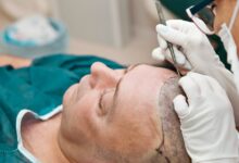 hair restoration Top 10 BEST Hair Transplant Clinics in Europe - 9 normal weight