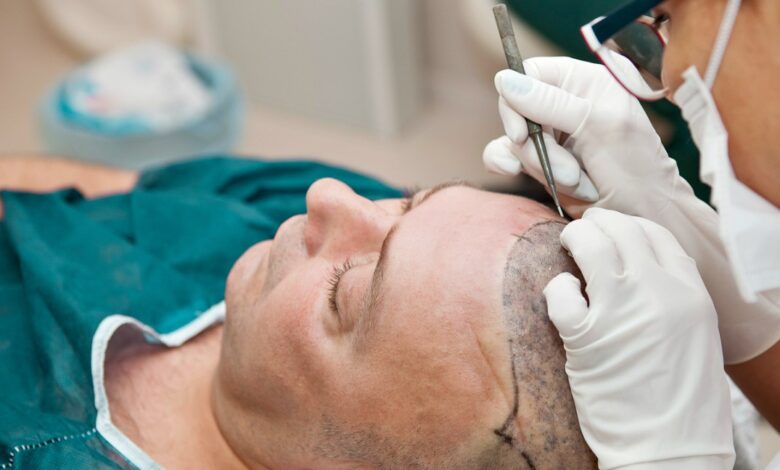 hair restoration Top 10 BEST Hair Transplant Clinics in Europe - healthcare services 1