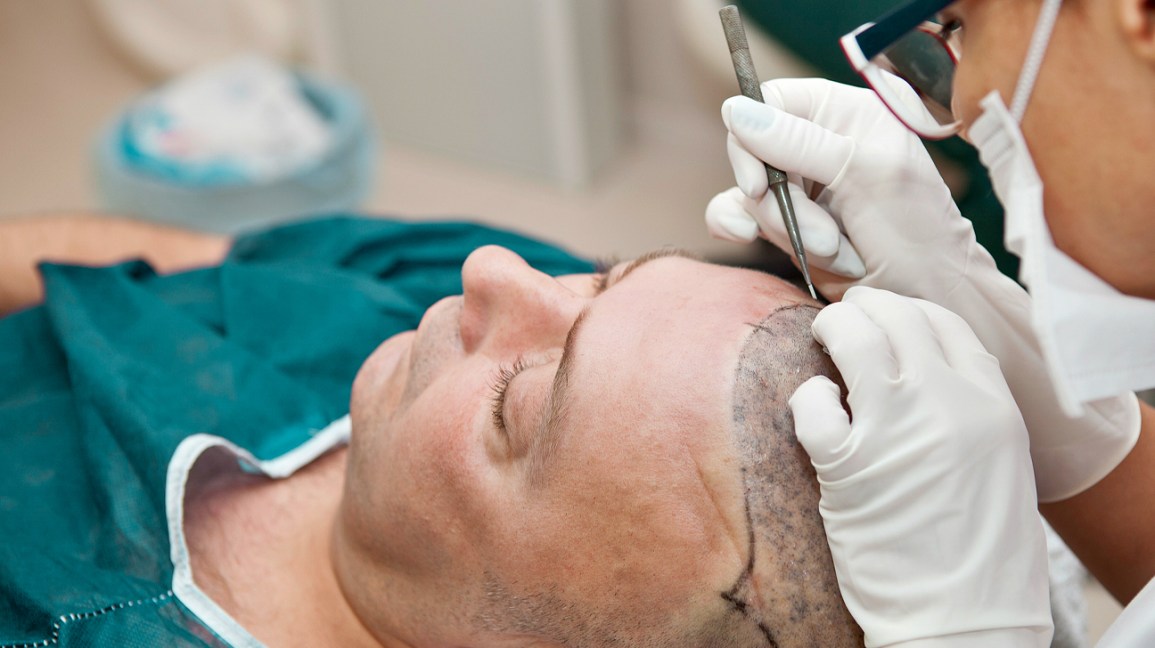 Top 10 BEST Hair Transplant Clinics in Europe 8 hair restoration Top 10 BEST Hair Transplant Clinics in Europe - 6
