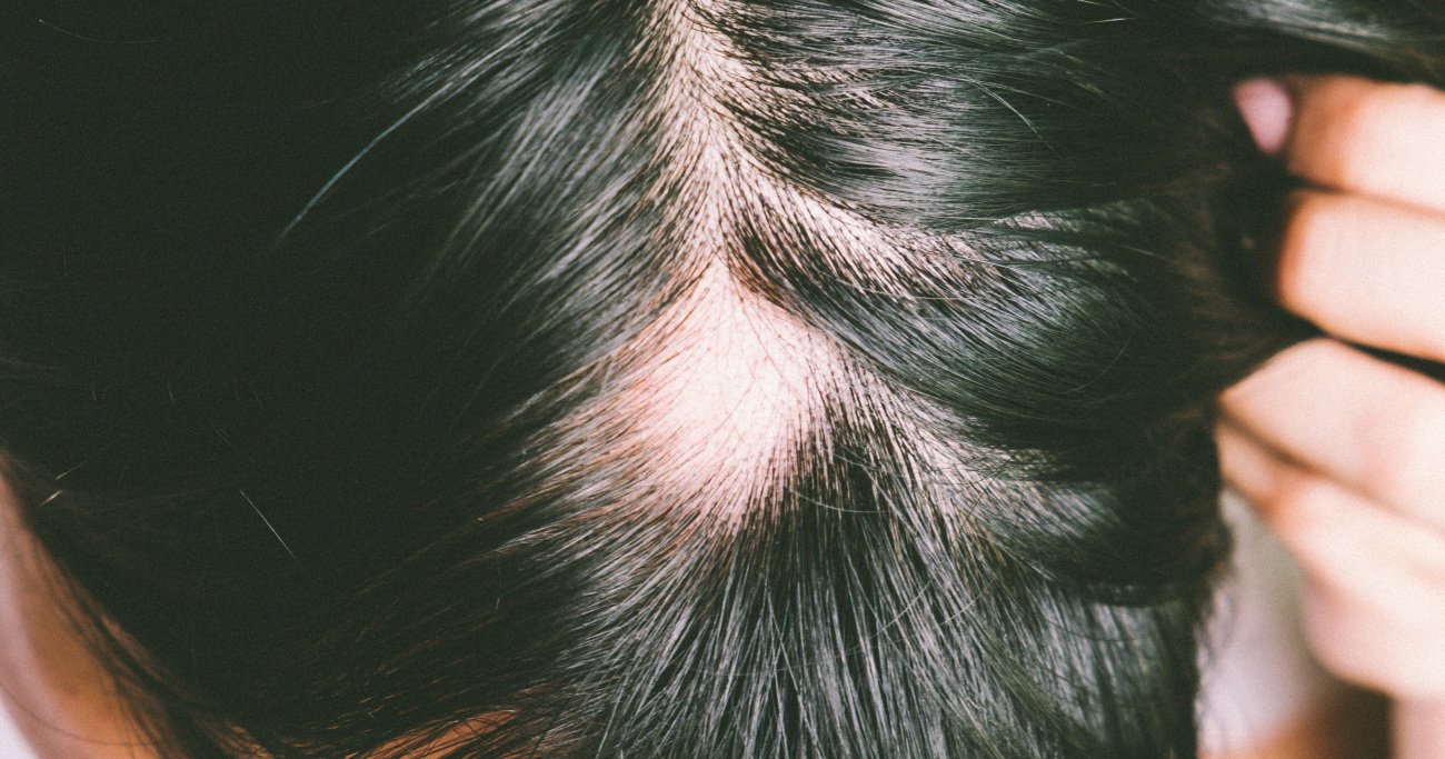 Top 7 Causes of Hair Loss: Symptoms and Causes of Alopecia 5 Alopecia Areata Top 7 Causes of Hair Loss: Symptoms and Causes of Alopecia - 5
