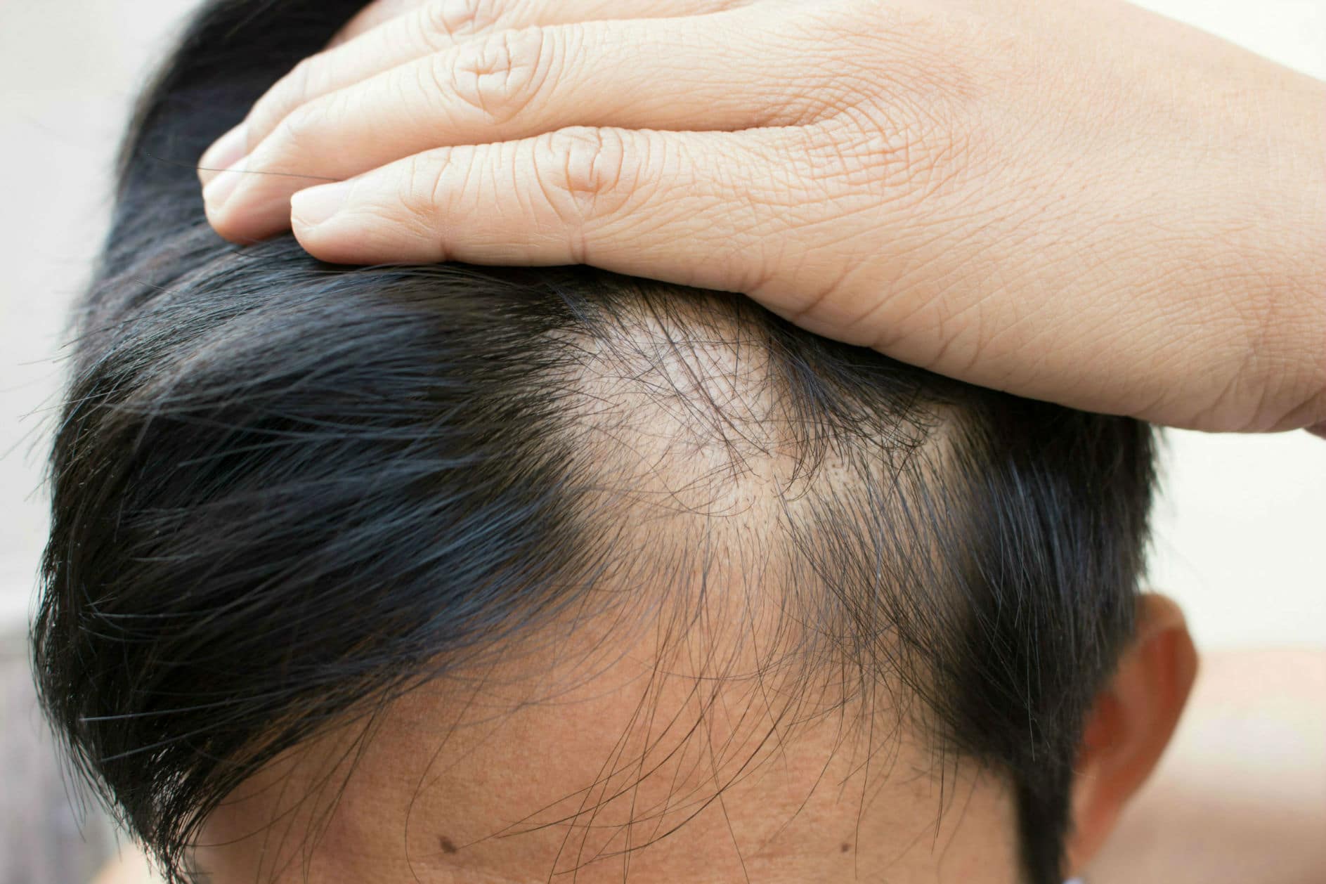 Top 7 Causes of Hair Loss: Symptoms and Causes of Alopecia 9 Poor Haircare Practices and Traction Alopecia Top 7 Causes of Hair Loss: Symptoms and Causes of Alopecia - 9